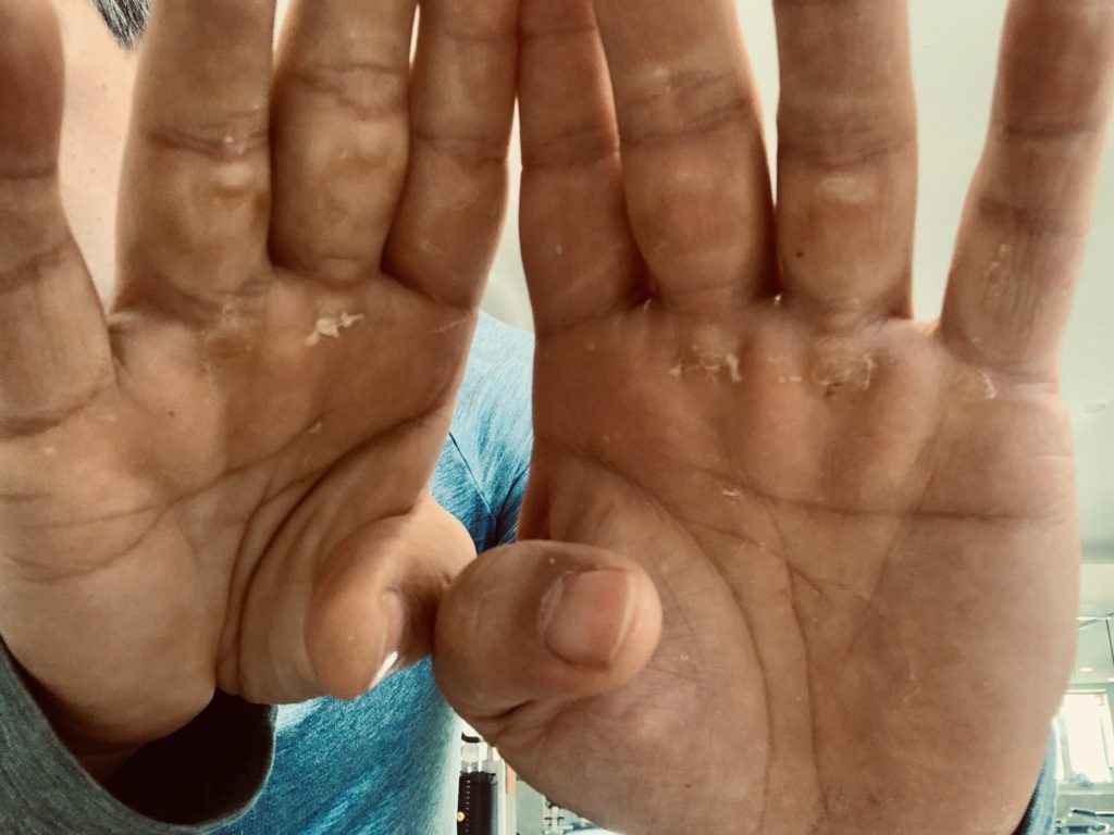 My hands, damaged from pull-up and hanging practice with callouses I have to file down or risk tearing off. 